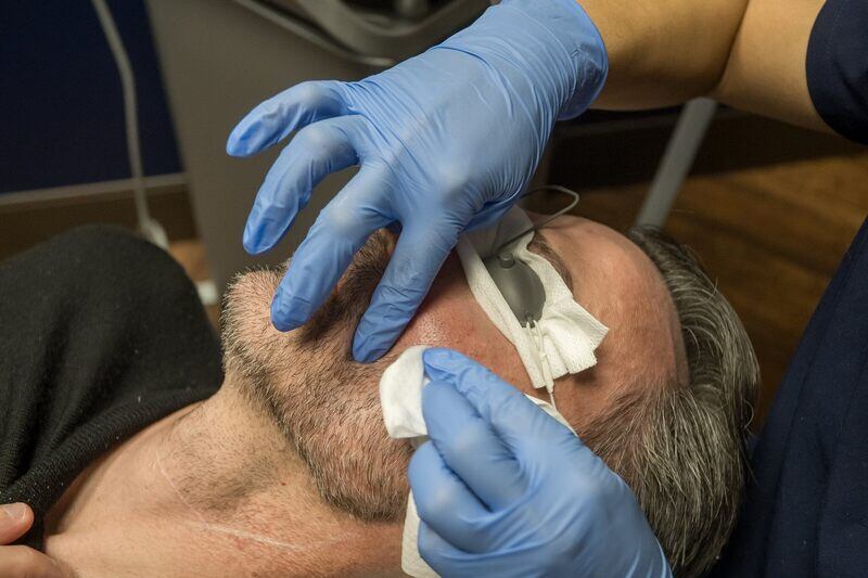 laser hair removal for facial hair post treatment