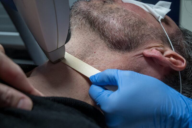 permanent facial hair reduction with laser