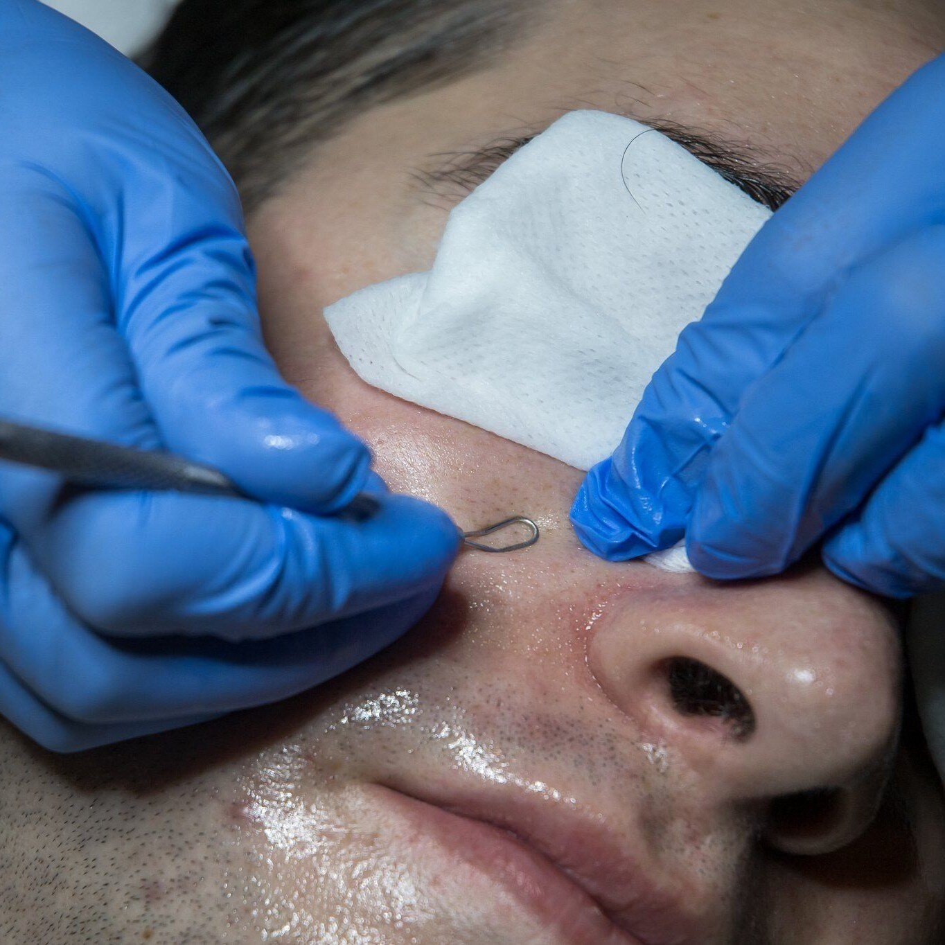 extractions for enlarged pores