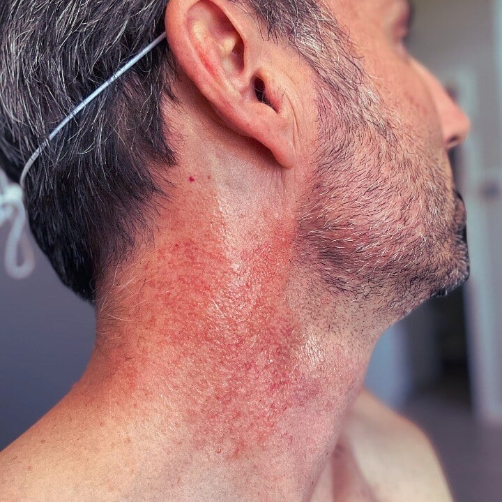 sun damage and redness on man's neck